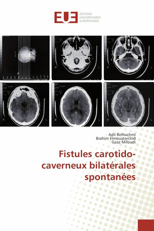 Fistules carotido-caverneux bilatérales spontanées