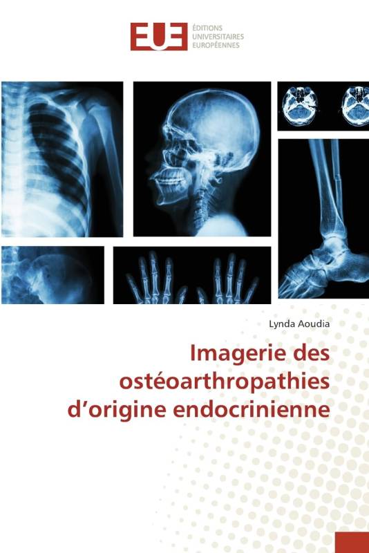 Imagerie des ostéoarthropathies d’origine endocrinienne