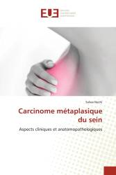 Carcinome métaplasique du sein