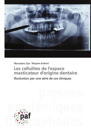 Les cellulites de l'espace masticateur d'origine dentaire